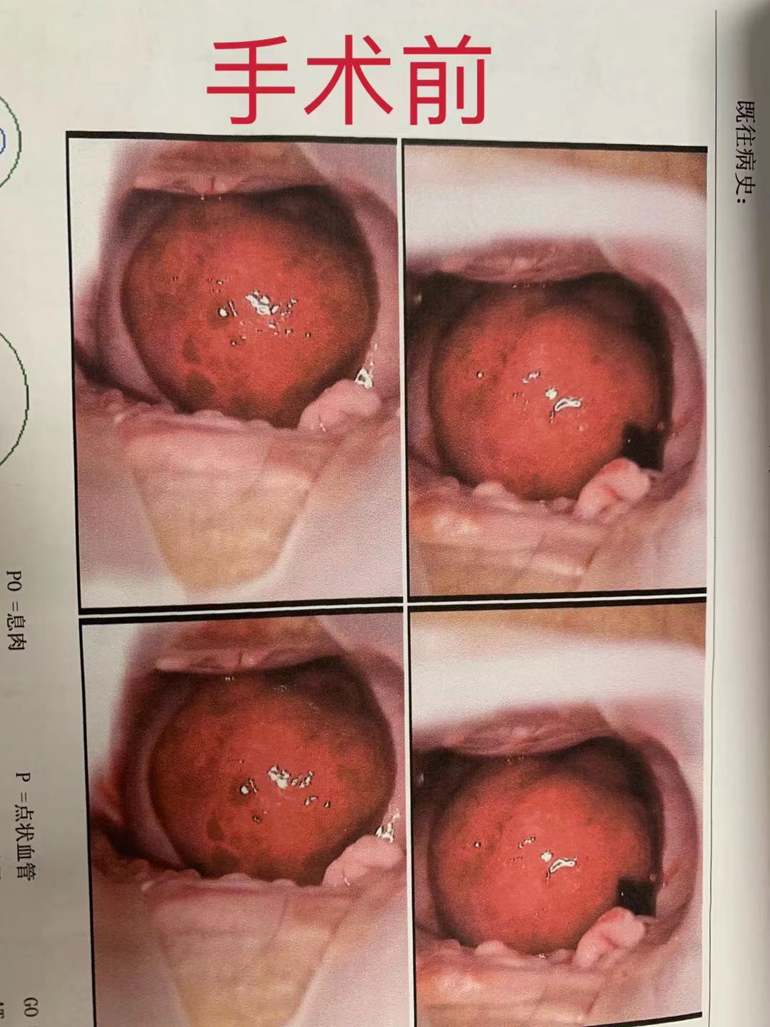术前.JPG